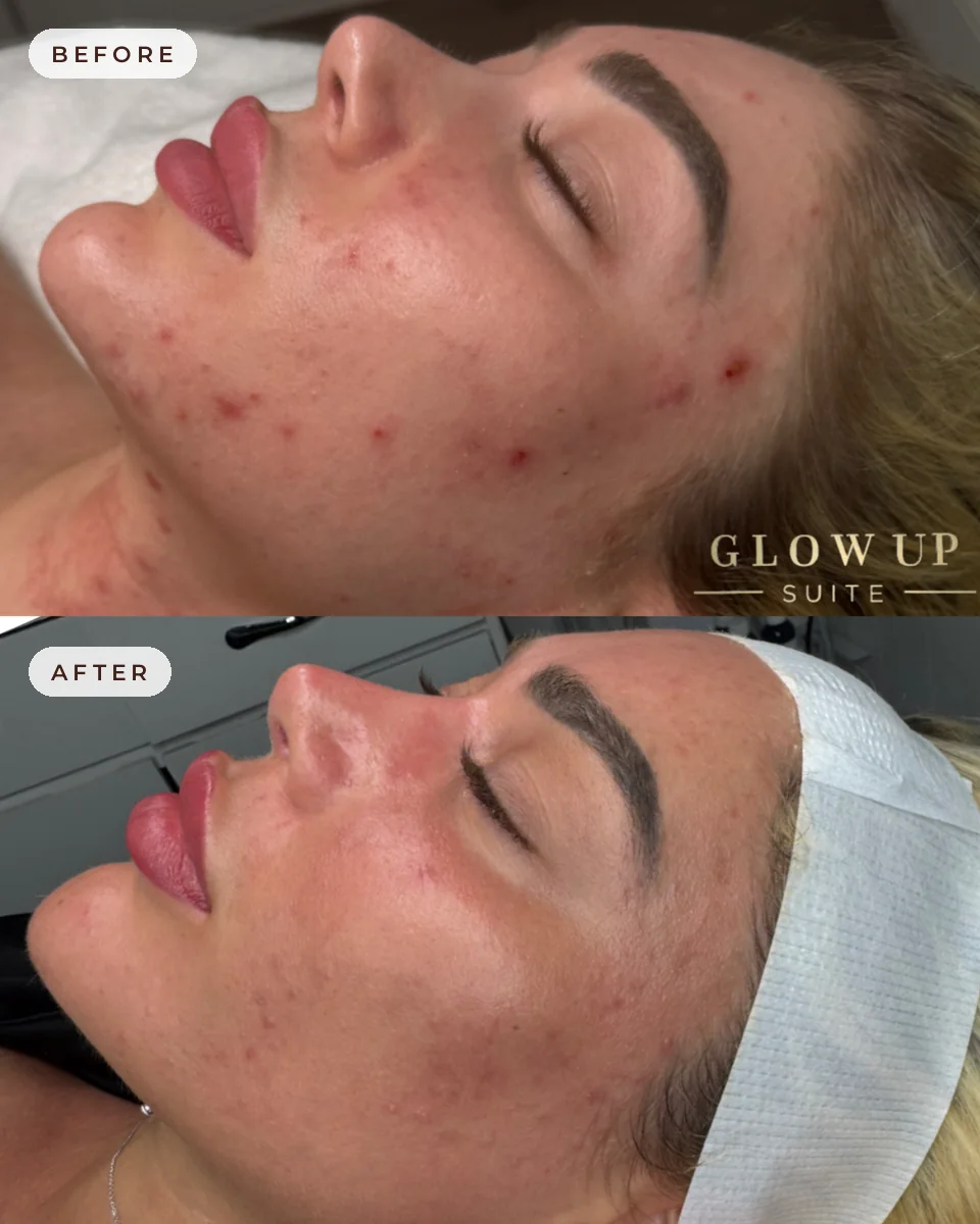 Before and after CoolJet cold plasma at Glow Up Suite