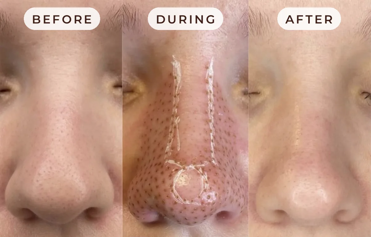 Fibroblast nose contouring before, during and after at Glow Up Suite