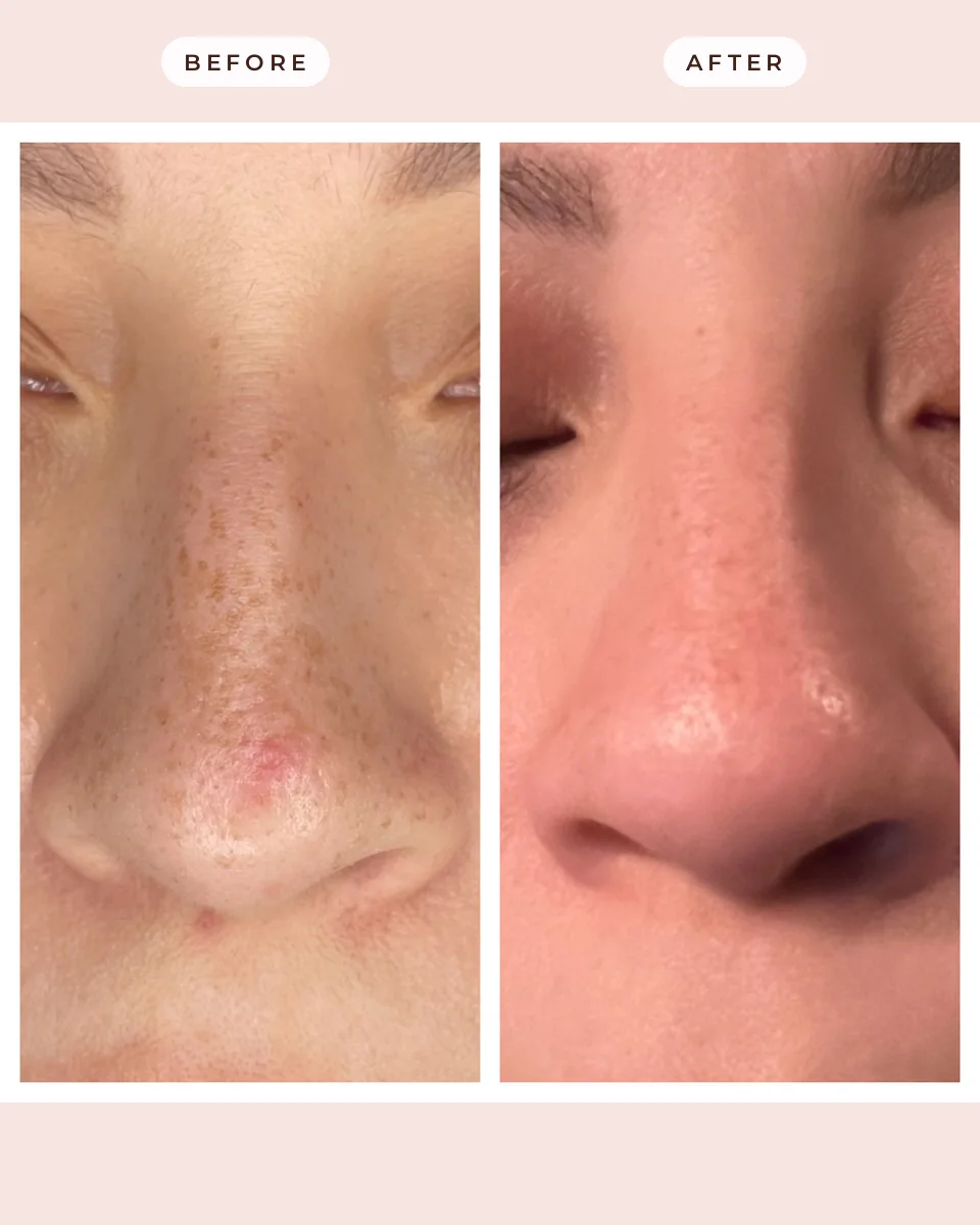 Before and after laser pigment removal at Glow Up Suite