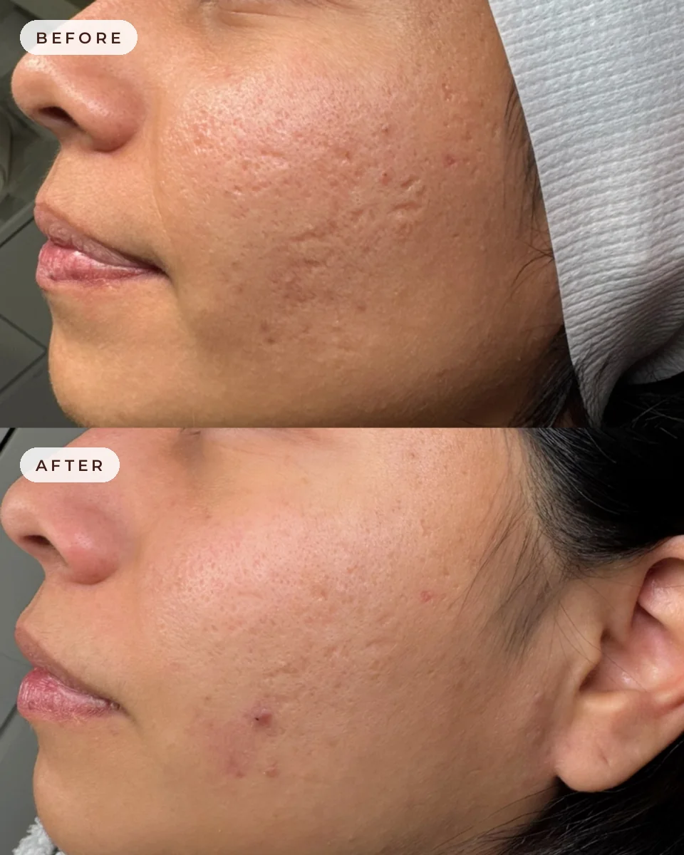 Before and after microneedling for acne scar texture at Glow Up Suite