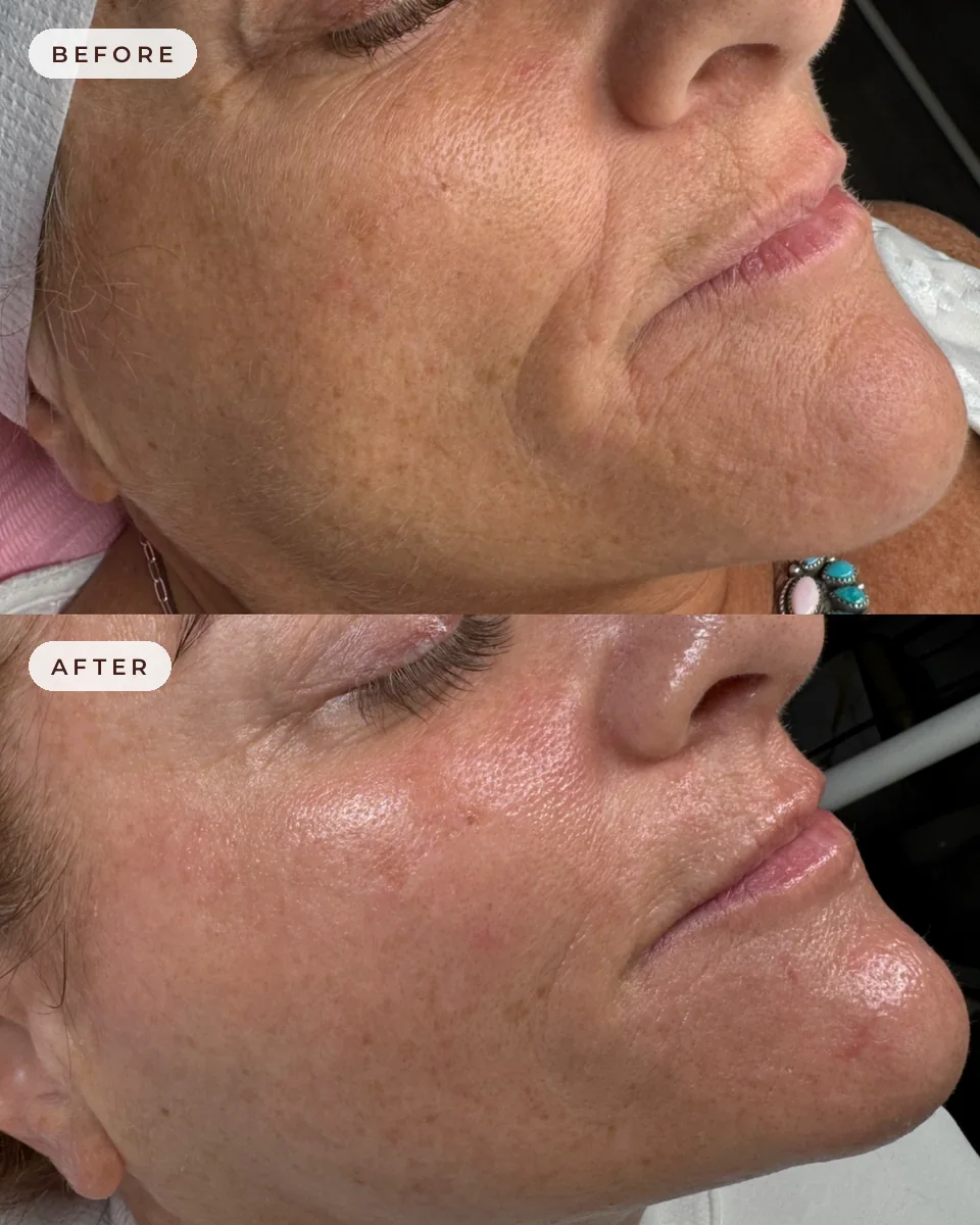 Before and after microneedling at Glow Up Suite